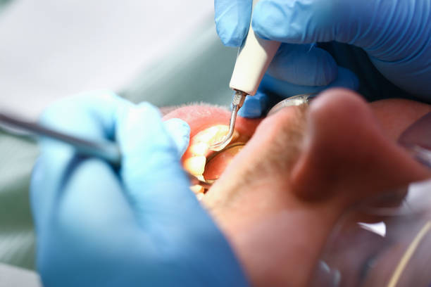 Best Dentist for Tooth Abscess  in Pennsboro, WV